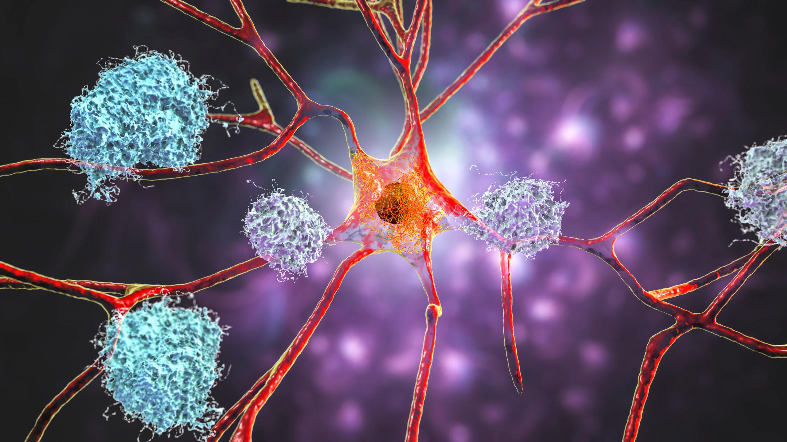 Illustration showing amyloid plaques around a neuron. 