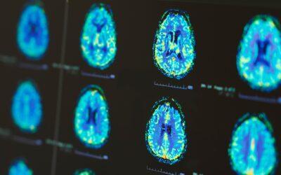 AI Tools Offer Improved Diagnosis via Brain Images
